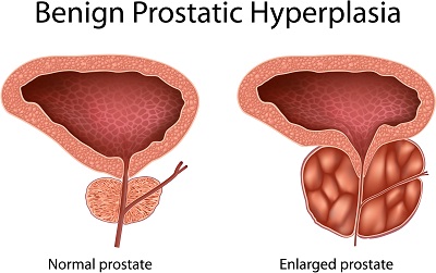 BPH, Prostate Problems and Catheters - Best Urologist NYC