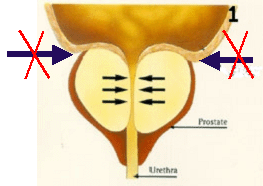 blocked-urination-bph-prostate-urologist-nyc-03