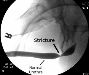 Why do urethral strictures recur after a urethral dilation or