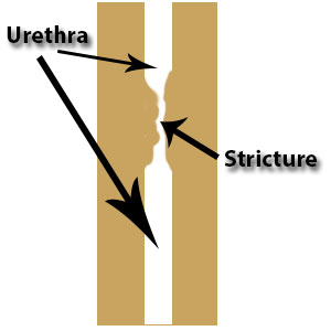 urethral stricture